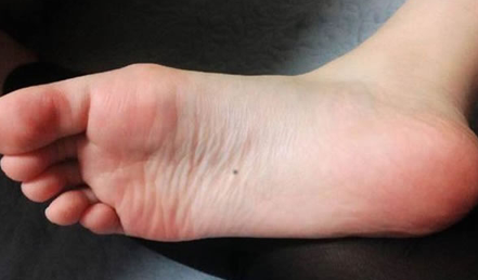 脚掌有痣代表什么 是好还是坏呢
