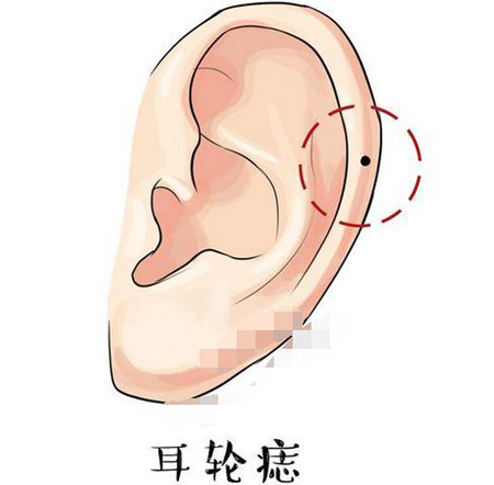 偏财痣在哪，偏财痣的位置